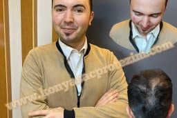 Nafiz Keskin Protez Saç Kliniği