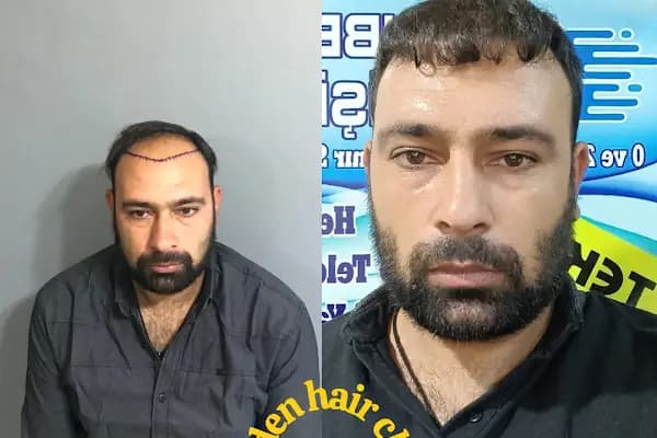 Estetik &amp; güzellik Şanliurfa Saç Ekim Merkezi /زراعة الشعر في أورفا - Sağlık ve Güzellik Merkezi - Şanlıurfa Eyyübiye