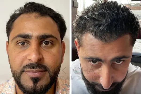 Back to Hair İstanbul - Saç Transplantasyonu Kliniği - İstanbul Avcılar