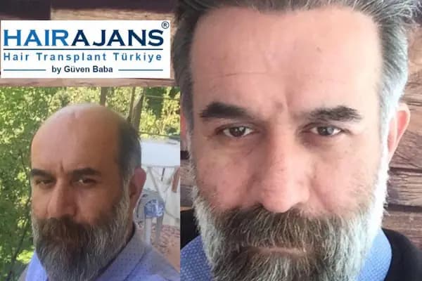 Hair Ajans Saç Ekim Merkezi - Saç Yenileme Hizmeti - İstanbul Arnavutköy