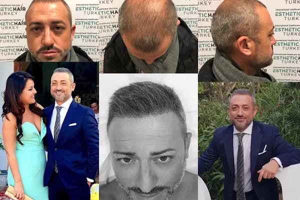 Esthetic Hair Turkey - Saç Transplantasyonu Kliniği - İstanbul Zeytinburnu