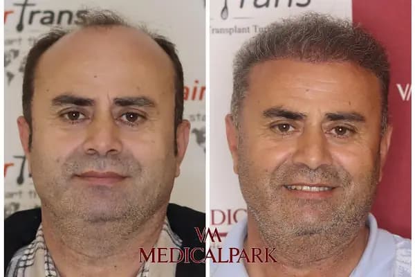 Hair Trans - Samsun Saç Ekimi - Saç Transplantasyonu Kliniği - Samsun 19 Mayıs