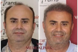 Hair Trans - Samsun Saç Ekimi