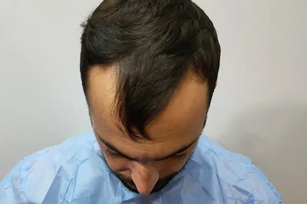 Saç Ekim Merkezi - Saç Transplantasyonu Kliniği - Ankara Çankaya