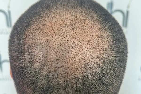 DHI Clinic Turkey - VIP DHI Hair Transplantation - Saç Transplantasyonu Kliniği - İstanbul Bağcılar