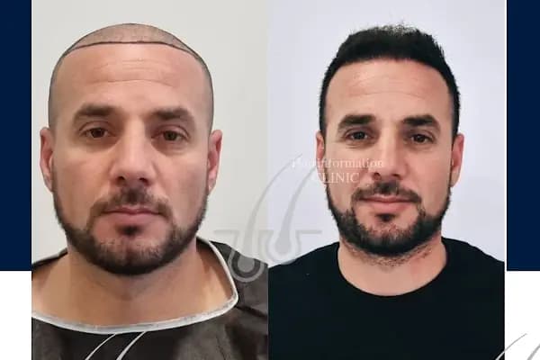 Hair Information Clinic - Saç Ekimi - Tıp Merkezi - İzmir Buca