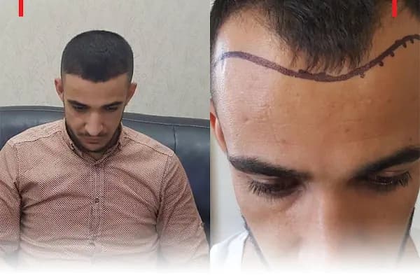 Fue Saç Ekimi Burak Karakaş - Saç Yenileme Hizmeti - Gaziantep Şehitkamil