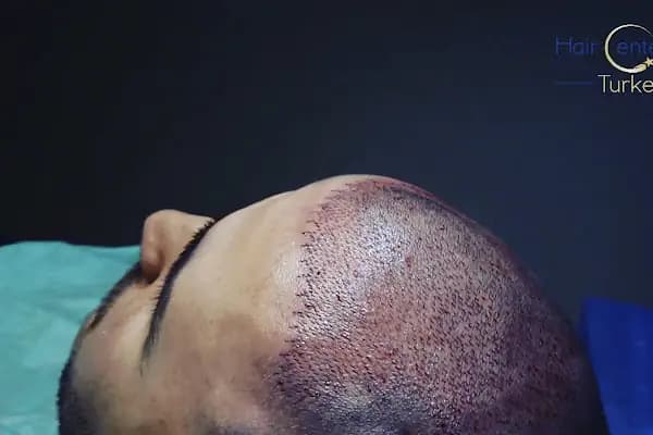 Hair Center of Turkey - Hair Transplant in Turkey, Istanbul - Saç Transplantasyonu Kliniği - İstanbul Bakırköy