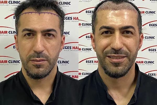 İzmir Saç Ekim Merkezi | Eges Hair Clinic - Sağlık Merkezi - İzmir Bayraklı