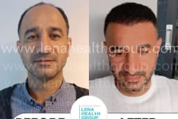 Lena Health Hairtransplant Turkey