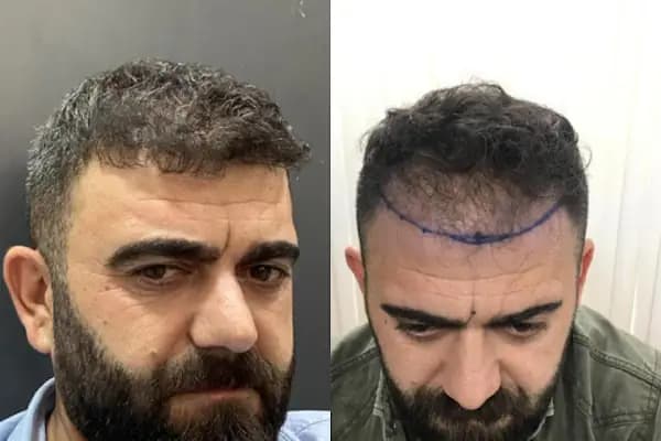 Güneydoğu Saç Ekimi - Saç Transplantasyonu Kliniği - Diyarbakır Çermik