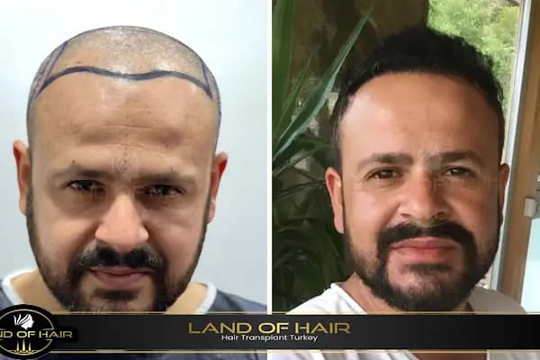 Land Of Hair - Hair Transplant Center / Istanbul Hair Transplant Center in Turkey - Saç Transplantasyonu Kliniği - İstanbul Başakşehir