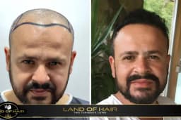 Land Of Hair - Hair Transplant Center / Istanbul Hair Transplant Center in Turkey