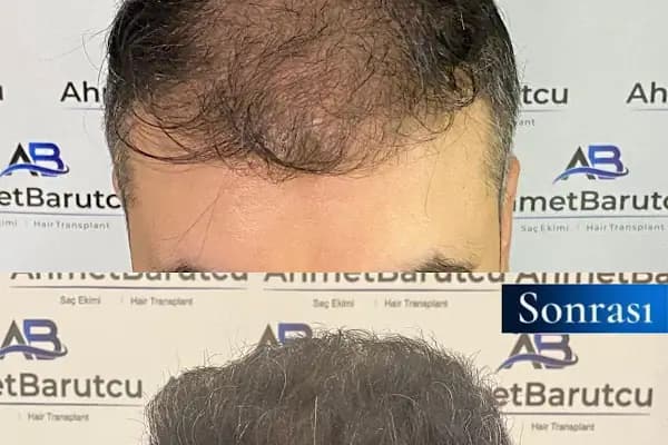 Ahmet Barutcu Saç Ekimi / Hair Transplant - Saç Transplantasyonu Kliniği - Ankara Çankaya