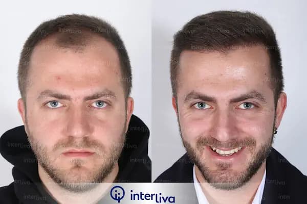 Aziz Aksöz - Hair Transplant Turkey,Hair Transplant İstanbul - Saç Transplantasyonu Kliniği - İstanbul Kadıköy
