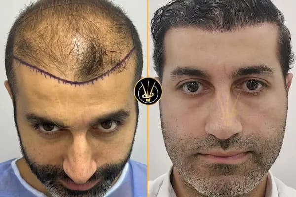 Real Of Hair - Hair Transplant Center in Turkey - Saç Transplantasyonu Kliniği - İstanbul Maltepe