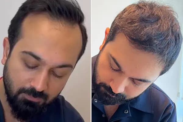 Dr.Gökeşme Hair Transplant - Saç Yenileme Hizmeti - İstanbul Ataşehir