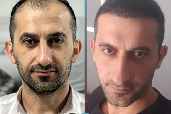 Esteweal Hair Clinic Saç Ekimi - Saç Transplantasyonu Kliniği - İstanbul Bakırköy