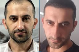 Esteweal Hair Clinic Saç Ekimi