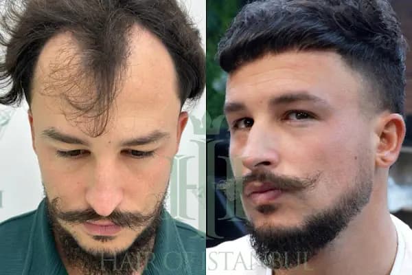 Hair of Istanbul | Hair Transplant - Saç Transplantasyonu Kliniği - İstanbul Bakırköy