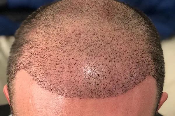 Ser Hair Center - Saç Transplantasyonu Kliniği - Ankara Çankaya
