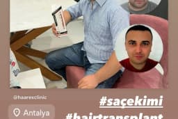 HAAREX CLİNİC SAÇ EKİM - HAİRTRANSPANT ANTALYA