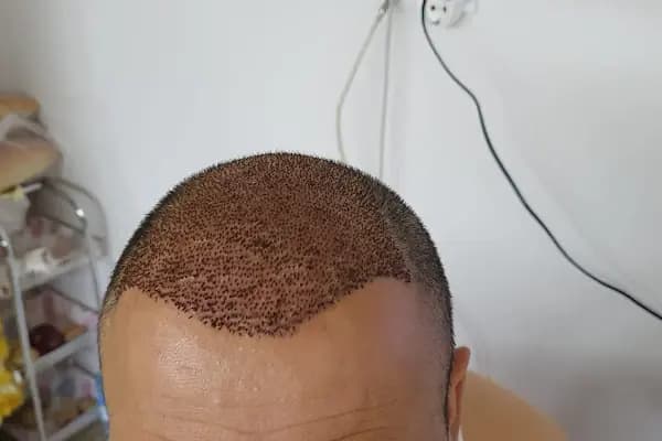 After Hair - Protez Saç Merkezi - Saç Ekim Kliniği - Saç Transplantasyonu Kliniği - Ankara Çankaya