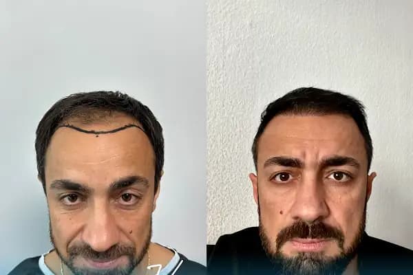Vialux Hair Transplant | Ankara Saç Ekimi - Saç Transplantasyonu Kliniği - Ankara Çankaya