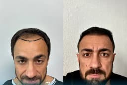 Vialux Hair Transplant | Ankara Saç Ekimi