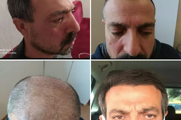 BAC Clinic - Saç Transplantasyonu Kliniği - İstanbul Ümraniye