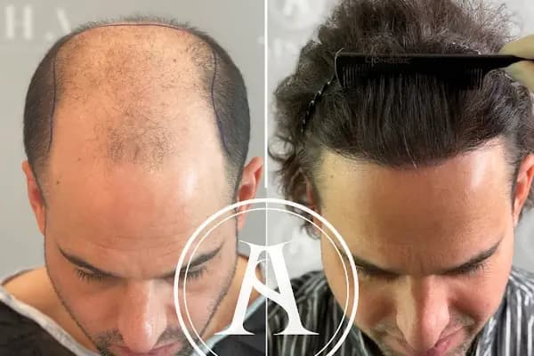 Aisha Hair | Injerto Capilar Turquía | Hair Transplant Turkey - Saç Transplantasyonu Kliniği - İstanbul Avcılar