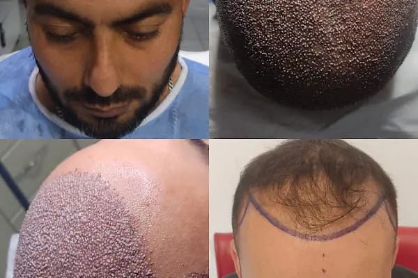 S&amp;U Protez Saçlandırma Merkezi - Saç Yenileme Hizmeti - Trabzon Ortahisar
