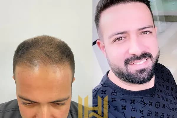 World Of The Hair - Saç Transplantasyonu Kliniği - İstanbul Küçükçekmece