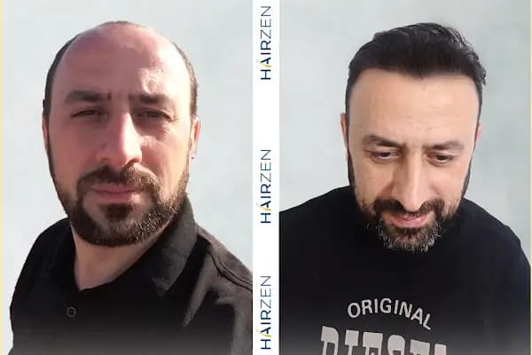 Hairzen Clinic - Saç Transplantasyonu Kliniği - İstanbul Ataşehir