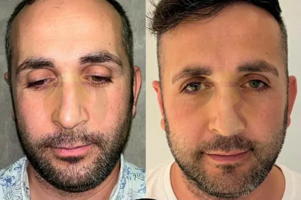 Transes Hair Transplant - Saç Transplantasyonu Kliniği - İstanbul Küçükçekmece