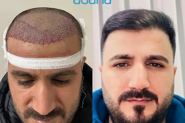 Adana Saç Ekim - Saç Transplantasyonu Kliniği - Adana Aladağ
