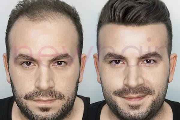 Newhair Bakırköy, Protez saç, Saç Protezi, Saç Ekimi, Kemoterapi, Hair Replacement, Toupee - Saç Yenileme Hizmeti - İstanbul Bahçelievler
