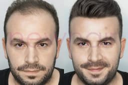 Newhair Bakırköy, Protez saç, Saç Protezi, Saç Ekimi, Kemoterapi, Hair Replacement, Toupee