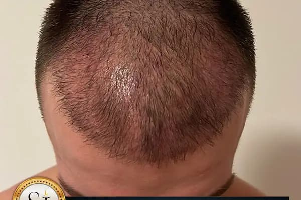 Si Hair Transplant in Turkey - Saç Transplantasyonu Kliniği - İstanbul Bakırköy