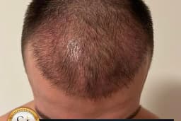Si Hair Transplant in Turkey