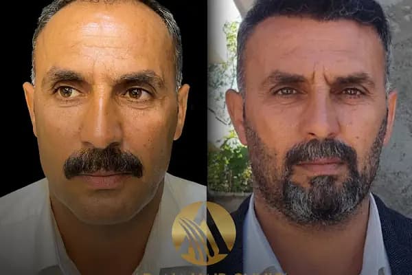 Simya Saç Ekimi &amp; Güzellik Merkezi - Hair Transplant Clinic in Turkey - Saç Transplantasyonu Kliniği - Adana Seyhan