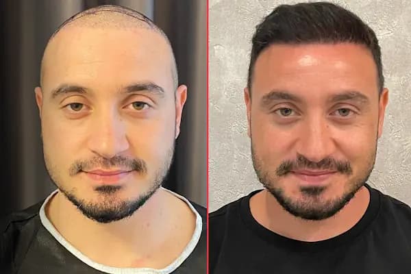 Cüneyt Arman - Saç Ekimi Ve Tedavileri - Saç Transplantasyonu Kliniği - İstanbul Bağcılar
