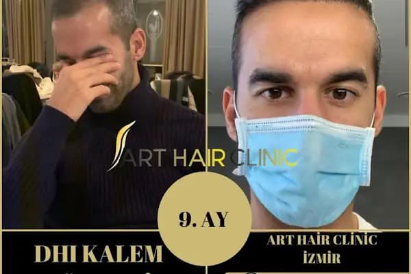 Saç Ekim Merkezi - Saç Transplantasyonu Kliniği - İzmir Bayındır