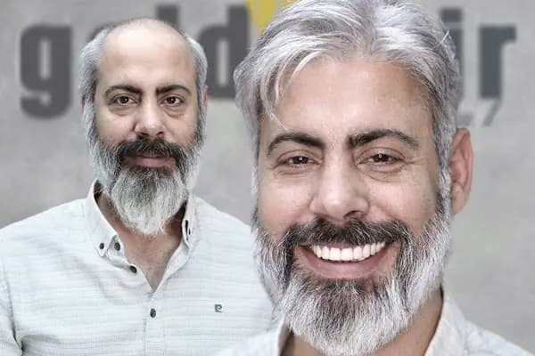 Gold Hair İstanbul - Protez Saç ve Gerçek Saç Merkezi | Real Hair Replacement Center - Saç Yenileme Hizmeti - İstanbul Bahçelievler