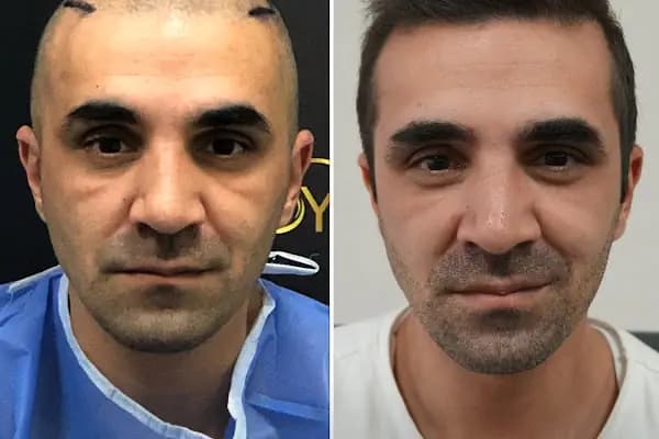 Trabzon Saç Ekim Merkezi Saç PRP`si | Altınsoy Hair Clinic - Saç Transplantasyonu Kliniği - Trabzon Ortahisar