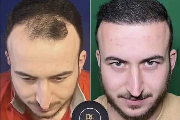 Data Hair Clinic &amp; Eyyüp Tütüncü Saç Ekim Merkezi - Saç Transplantasyonu Kliniği - Ankara Çankaya