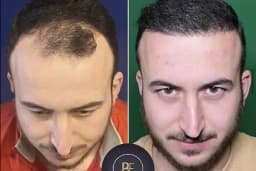 Data Hair Clinic &amp; Eyyüp Tütüncü Saç Ekim Merkezi