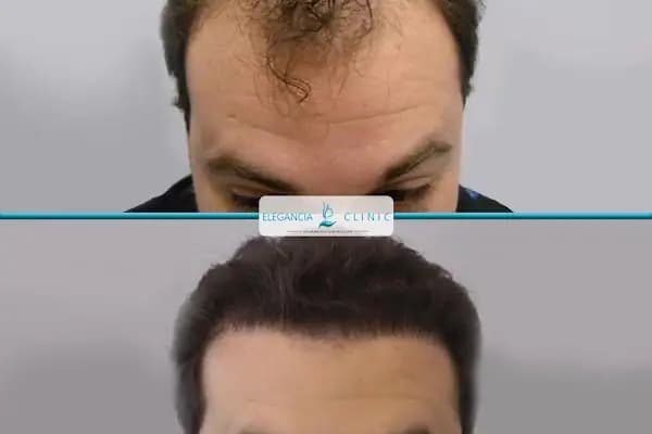 Elegancia Clinic - Saç Transplantasyonu Kliniği - İstanbul Avcılar