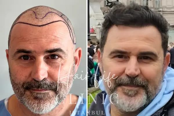 Cem Estetik &amp; Saç Ekim Merkezi - Saç Transplantasyonu Kliniği - İstanbul Kartal