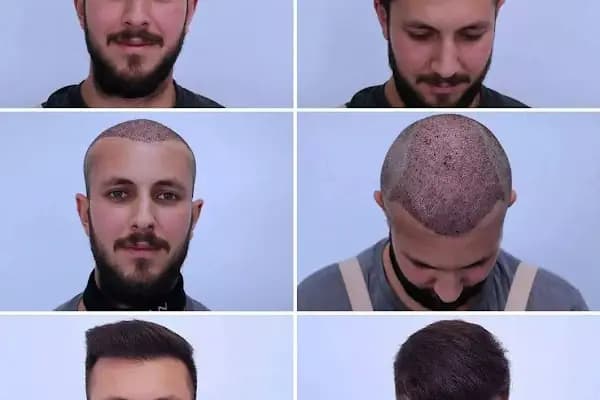 Siverek saç ekim merkezi - Güzellik Salonu - Şanlıurfa Akçakale